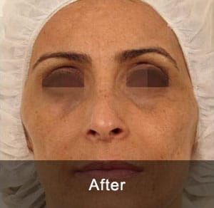 GeneO + 4-in-1 Facial Treatment 4 After6 2