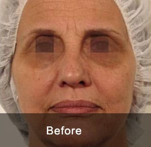 GeneO + 4-in-1 Facial Treatment 5 Before5 2
