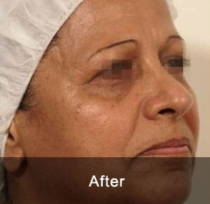 GeneO + 4-in-1 Facial Treatment 2 After
