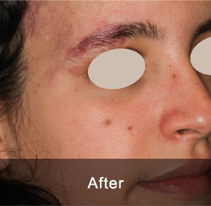 IPL Treatment 10 After2 6 1