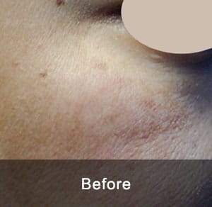 IPL Treatment 7 Before2 1 1