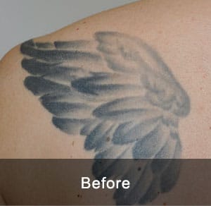 IPL Treatment 11 Before2 3