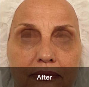 GeneO + 4-in-1 Facial Treatment 6 After5 2
