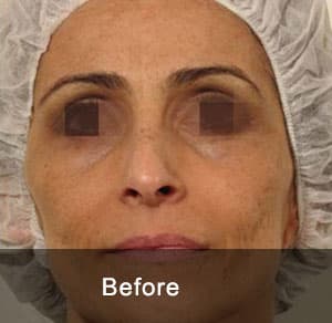 GeneO + 4-in-1 Facial Treatment 3 Before6 2