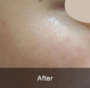 IPL Treatment 8 After1 1
