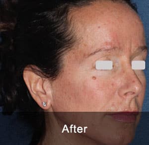 IPL Treatment 2 After1