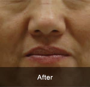 IPL Treatment 6 After2 2 1