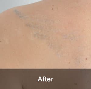IPL Treatment 12 After2 3