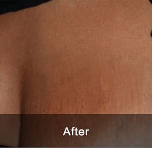 IPL Treatment 4 After3