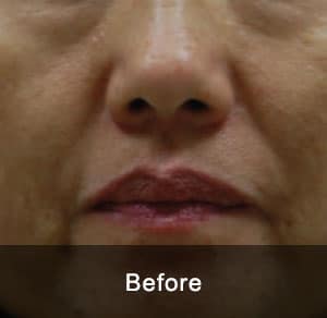 IPL Treatment 5 Before2 2 1