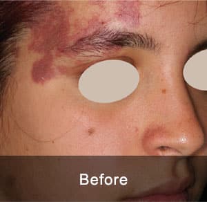 IPL Treatment 9 Before2 6 1