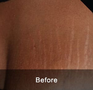 IPL Treatment 3 Before3