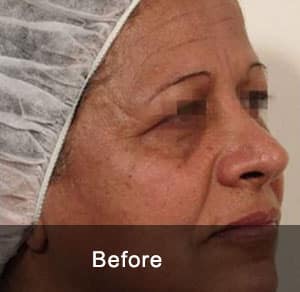 GeneO + 4-in-1 Facial Treatment 1 Before4