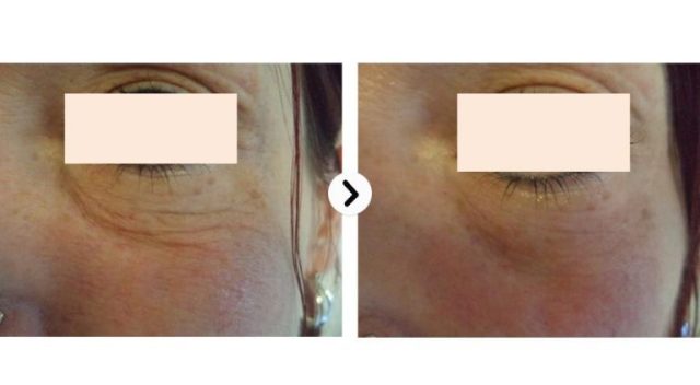 Copy Of Face Lifting Ultraformer