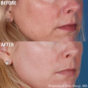 ZO Obagi Skin care 4 Skin Treatments Before After 12