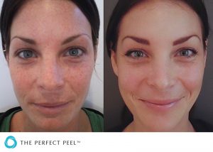 Skin Treatments Before After 18