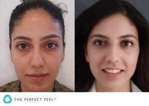 The Perfect Peel - Richmond