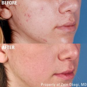 ZO Obagi Skin care 3 IPL treatment for acne Skin Treatments Before After 7