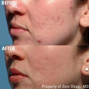 ZO Obagi Skin care 2 Skin Treatments Before After 8