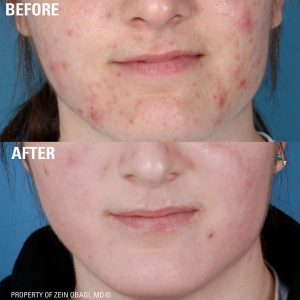 ZO Obagi Skin care 1 skinpen Treatments for acne Before After 9