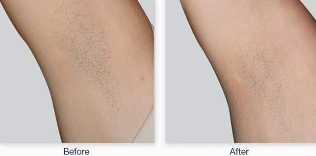 Laser Hair Removal 4 Laser Hair Removal