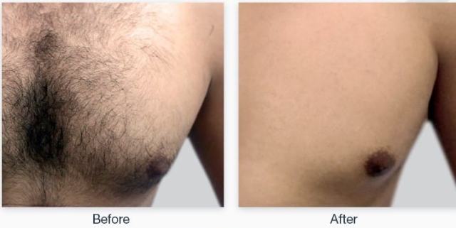Laser Hair Removal 3 Laser Hair Removal