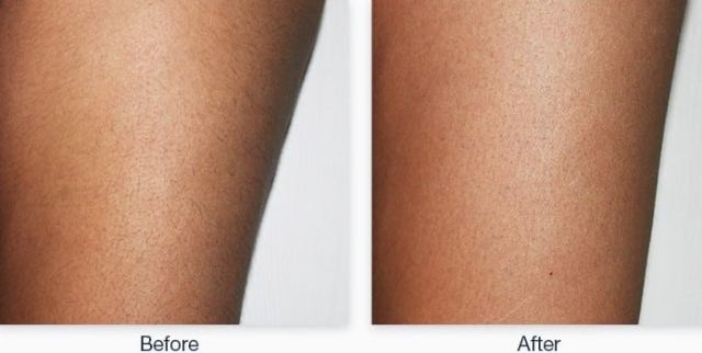 Laser Hair Removal 2 Laser Hair Removal