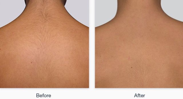 Laser Hair Removal 5 Laser Hair Removal