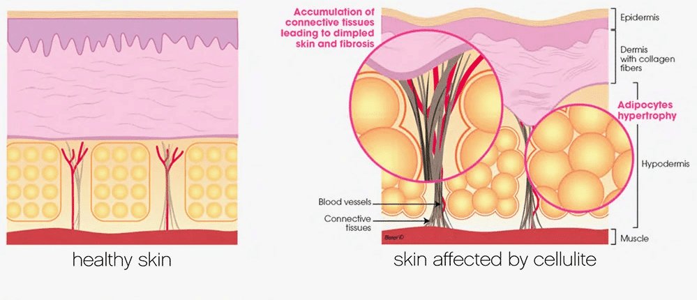 Targeted Solutions-Cellulite 2 image 2020 10 14T10 45 34 595Z HSA Dermal Clinic
