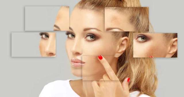 Woman with melasma and pigmenmtation