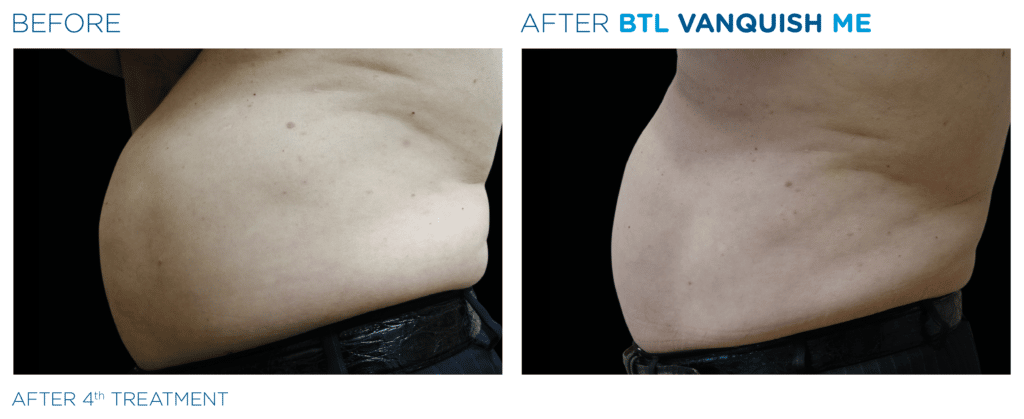 Belly fat reduction treatment Richmond