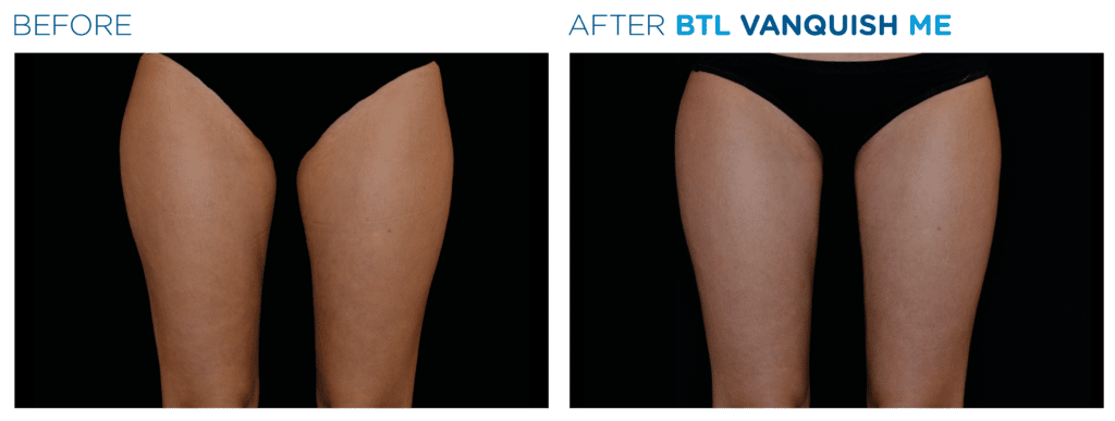 Non-surgical body contouring treatment Richmond