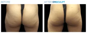 Emsculpt PIC Ba Card Female Buttock 005 EN100 E1644890135297