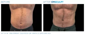 Emsculpt PIC Ba Card Male Abdomen 007 EN100 E1644890372250