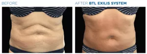 BTL Exilis System PIC Ba Card Female Abdomen 007 EN100 E1644889962764