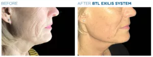 BTL Exilis System PIC Ba Card Female Face Neck 012 EN100 E1644889934119