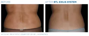 BTL Exilis System PIC Ba Card Female Love Handles 008 EN100 1 E1644889896928