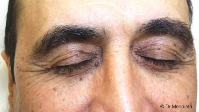 Skin Tags Removal 6 PICS B A Eye 02 Before 1