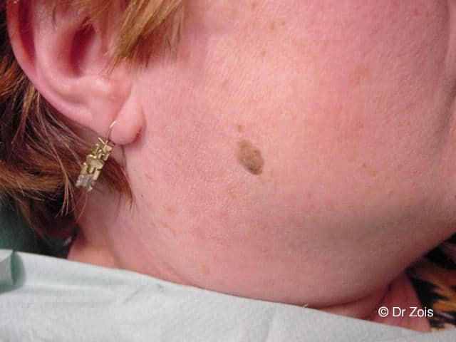 Skin Tags Removal 4 PICS B A Cheek 02 A 1