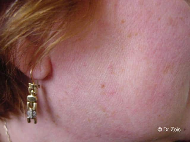 Skin Tags Removal 5 PICS B A Cheek 02 B 1