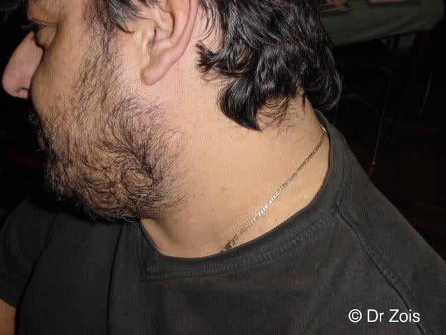 Skin Tags Removal 3 PICS B A Hemangioma 01 After 1