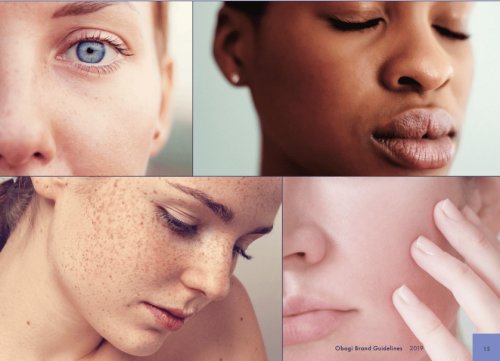 Face & Neck Conditions 1 face and neck, Hyperpigmentation treatment is available at HSA Dermal Clinic, Aesthetics and skin clinic
