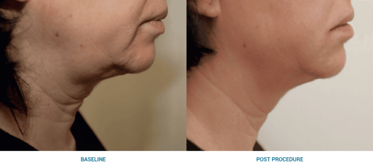 Non Surgical Face Lift