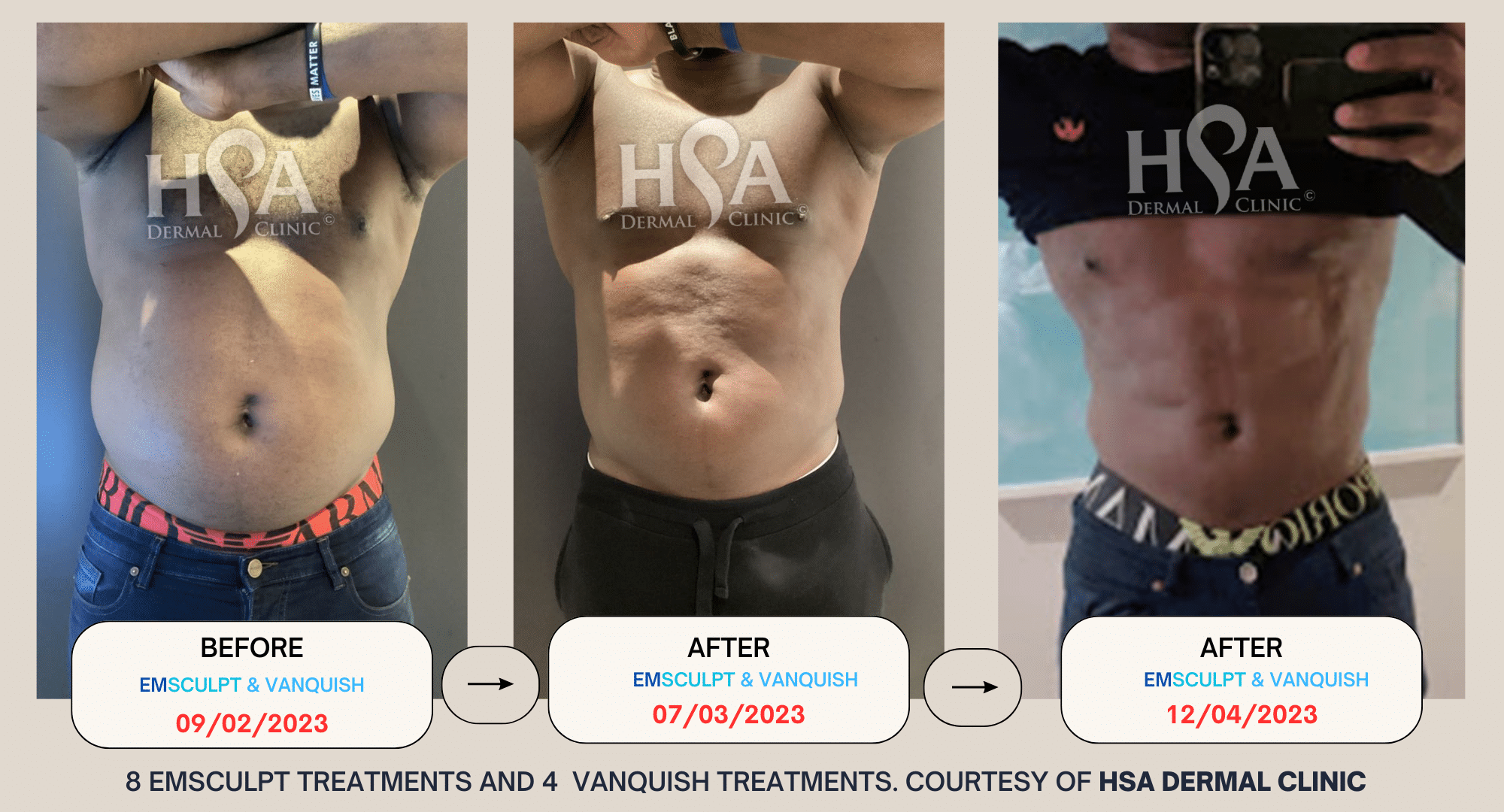 Copy Of EMSCULPT BEFORE AND AFTER