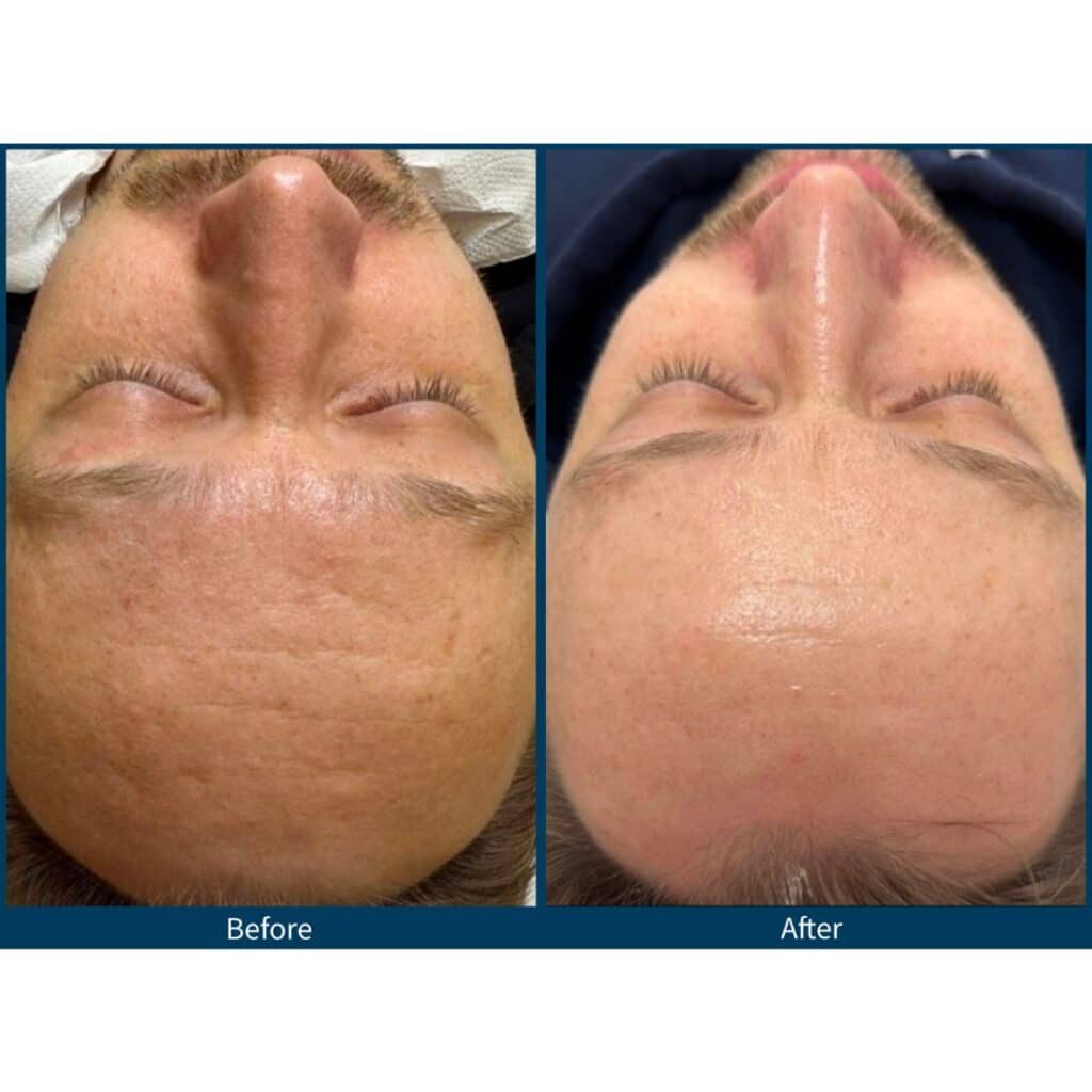 SkinPen Microneedling