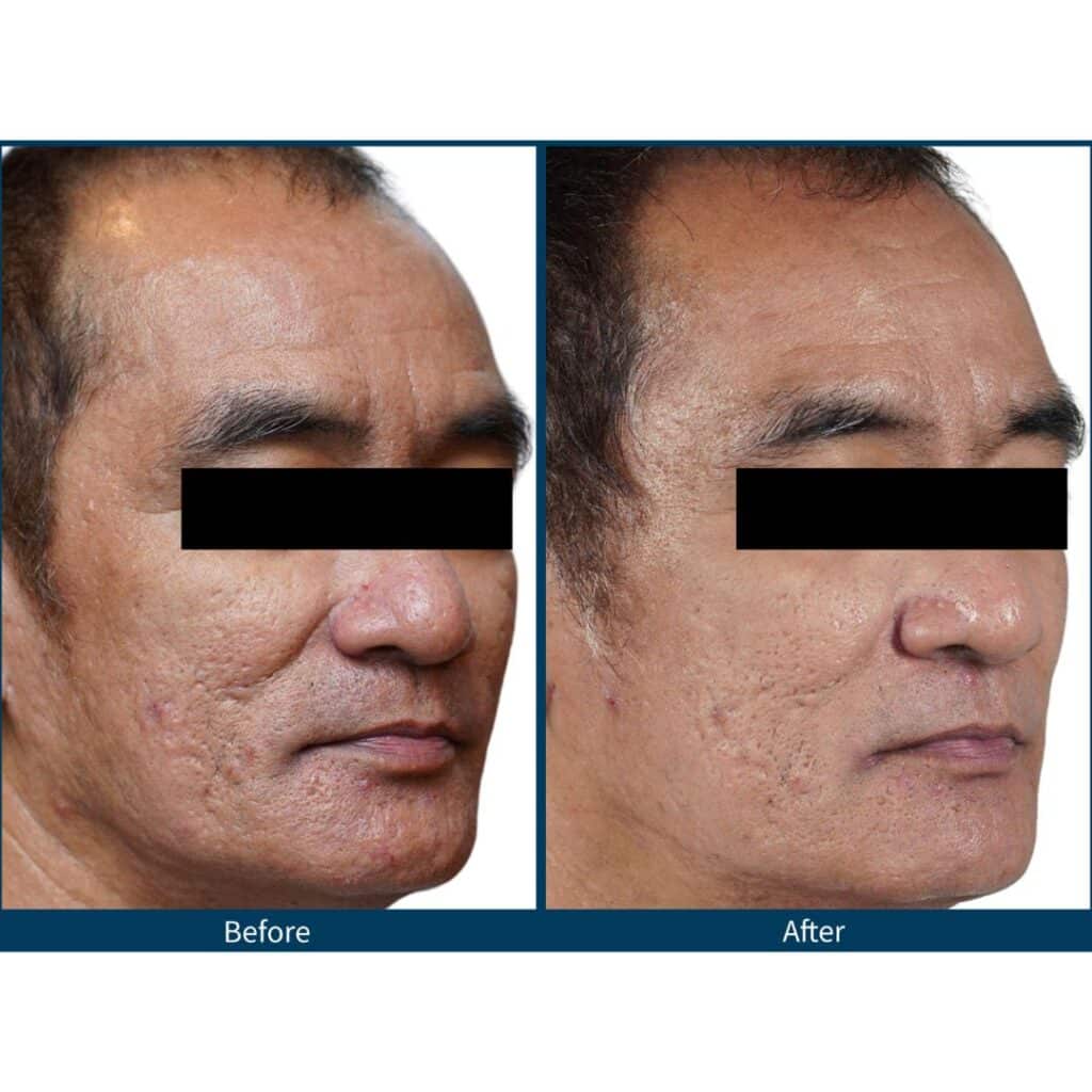 SkinPen Microneedling