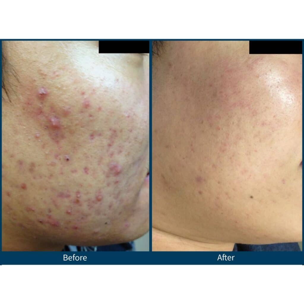 SkinPen Microneedling