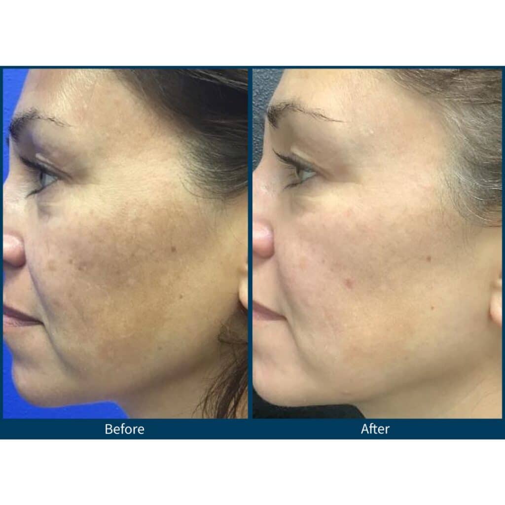 SkinPen Microneedling