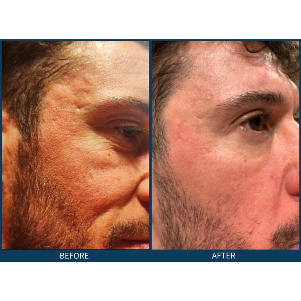 SkinPen Microneedling